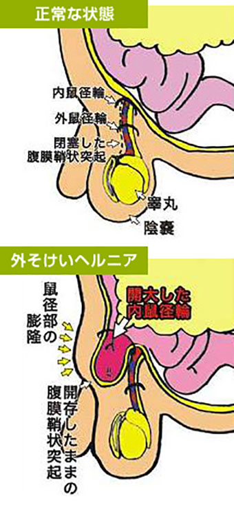 鼠径ヘルニア 脱腸 は日帰り手術 大阪市の多根総合病院